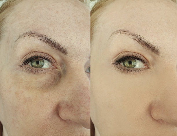 女性眼部皱纹治疗前后，眼睑成形术图片下载
