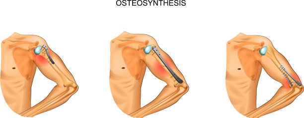 肱骨接骨术图片下载