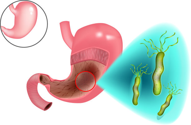胃炎幽门螺杆菌图片下载
