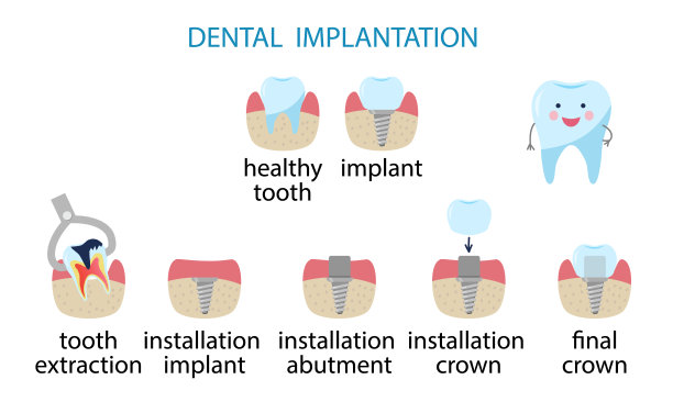 信息图牙科植入。种植体安装的阶段。图片下载
