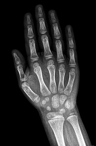 孩子手的x光片图片下载