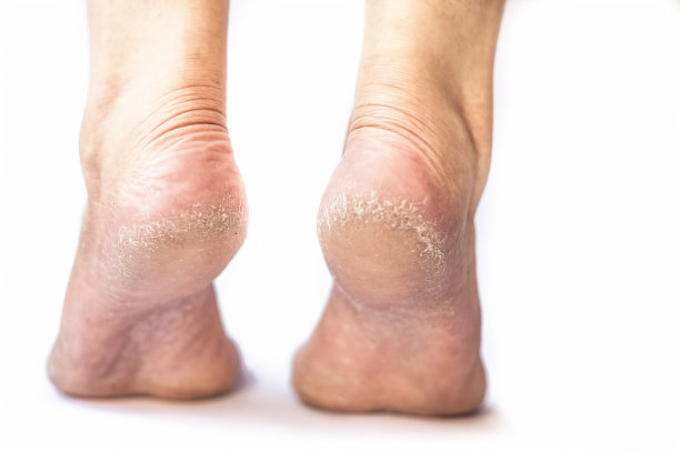 一双开裂的鞋跟孤立在一个白色的背景。图片下载