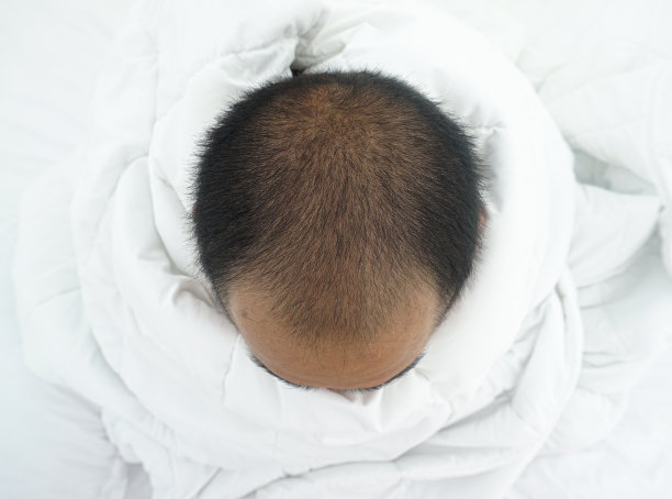 一个高角度的观点，一个秃顶的亚洲人坐在床上，拥抱一个白色的毯子图片下载