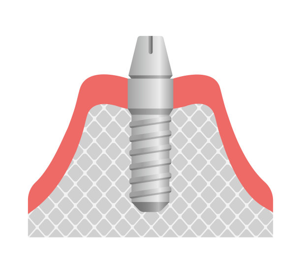 种植体平面矢量图/附着基台图片下载