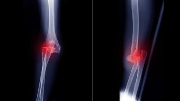 肘关节x光片显示肘关节脱位。病人因跌倒造成关节脱位。脱位部位和疼痛部位呈红色。医学影像和诊断概念图片下载