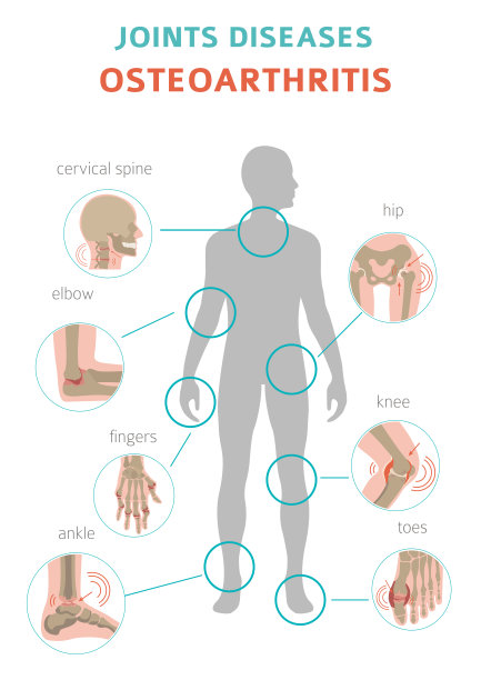 关节炎、骨关节炎医疗信息图设计。关节置换,implantant图片下载