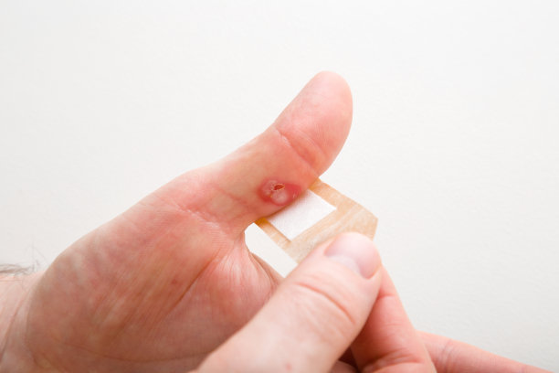 一名年轻人在拇指烧伤后用胶布包扎。急救。自我帮助。医学概念。特写镜头。视角拍摄。图片下载
