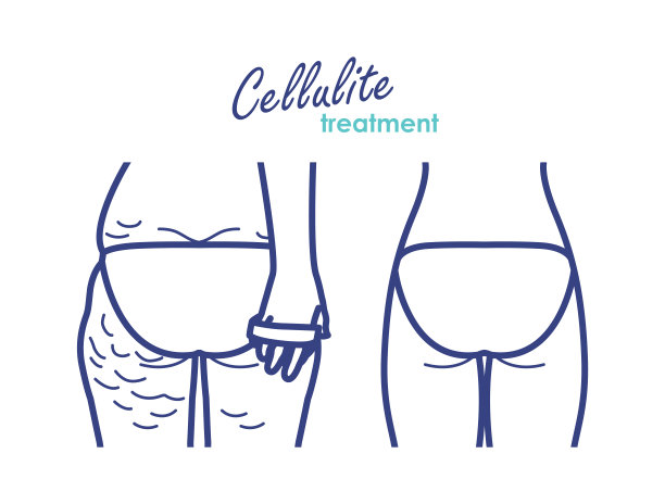 减少臀部脂肪和脂肪团。关于身体护理的矢量线插图图片下载