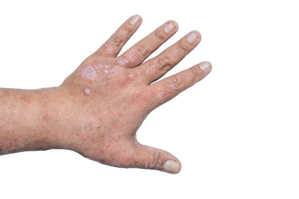 手银屑病患者。牛皮癣是一种自身免疫性疾病，影响皮肤，导致皮肤炎症红色和鳞屑。图片下载