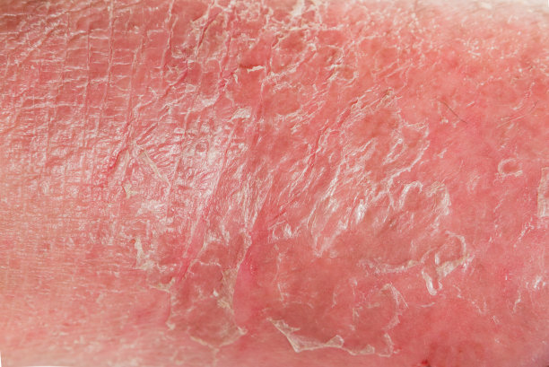 牛皮癣的皮肤。牛皮癣是一种自身免疫性疾病，影响皮肤，导致皮肤炎症红色和鳞屑。图片下载