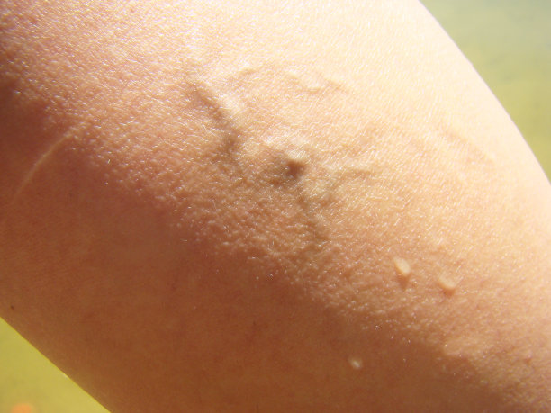 静脉曲张的图片下载