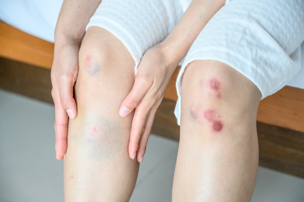 女人受伤的镜头，她的腿上有淤青(注意左腿)。因坠落或撞击地面而受伤。图片下载