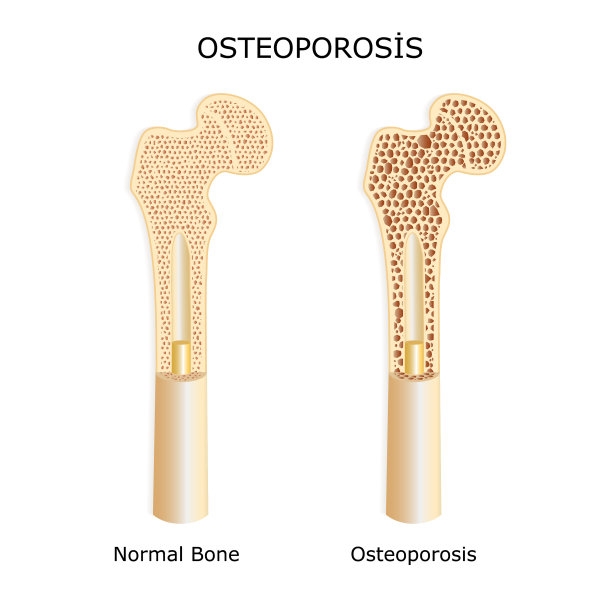 骨质疏松患者的骨骼结构图片下载