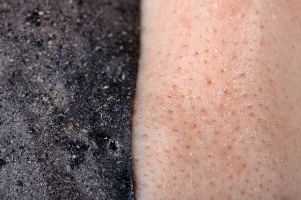 皮肤问题区域。用木炭去除痤疮和清洁皮肤的去角质化妆品面膜。图片下载