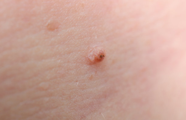 Keratopapilloma皮肤图片下载