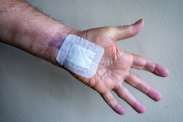 摘除手术缝线后手腕有淤青图片下载