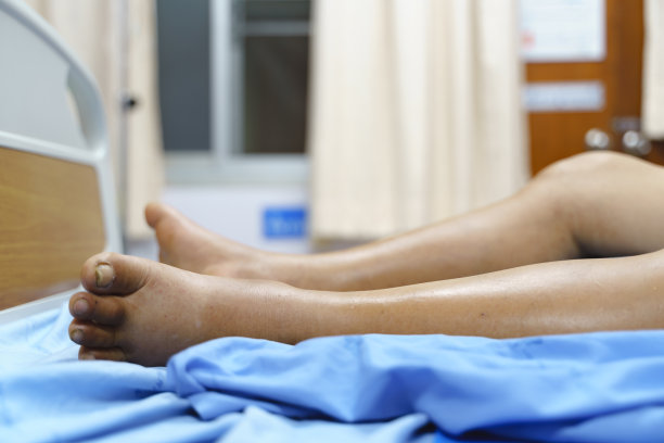 腿部水肿病人图片下载