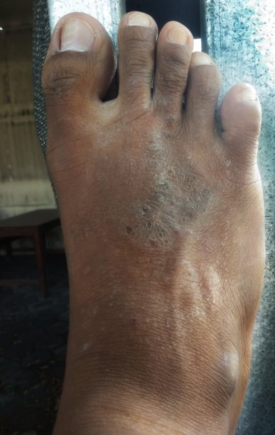 烧伤脚的特写图片下载