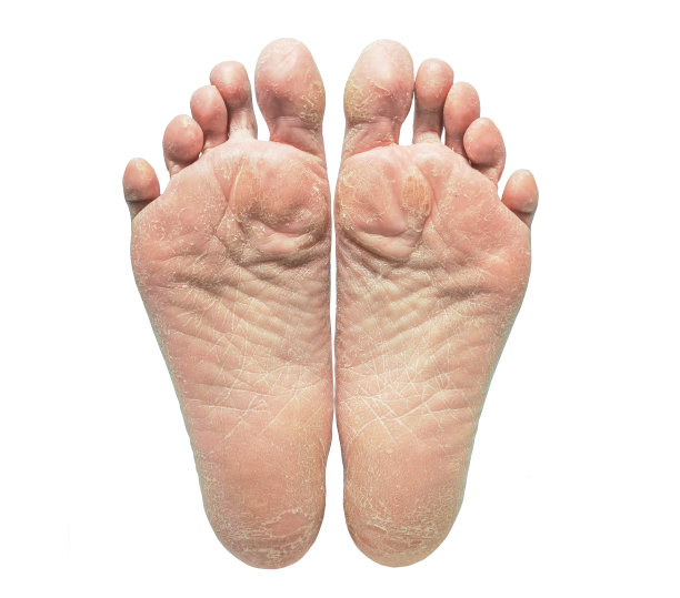 赤足干燥皮肤脱皮和裂纹的特写在白色的背景。保健护肤理念图片下载