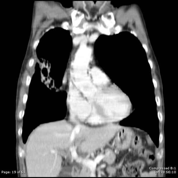 男性77岁，肺脓肿伴肺炎图片下载
