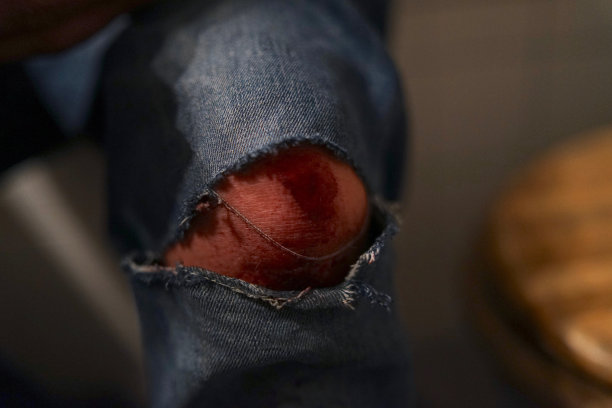 事故发生后在破牛仔裤下擦伤膝盖，伤口有血图片下载