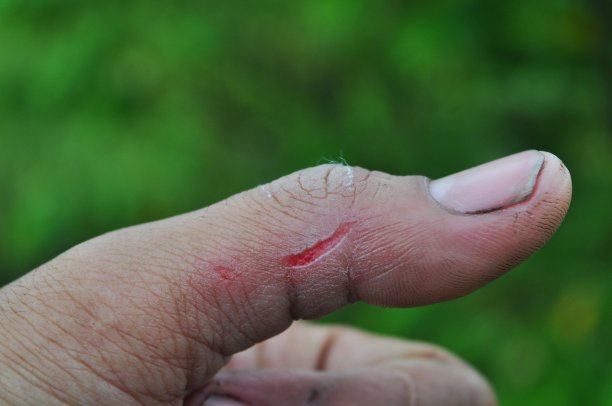 闭合受伤的拇指图片下载