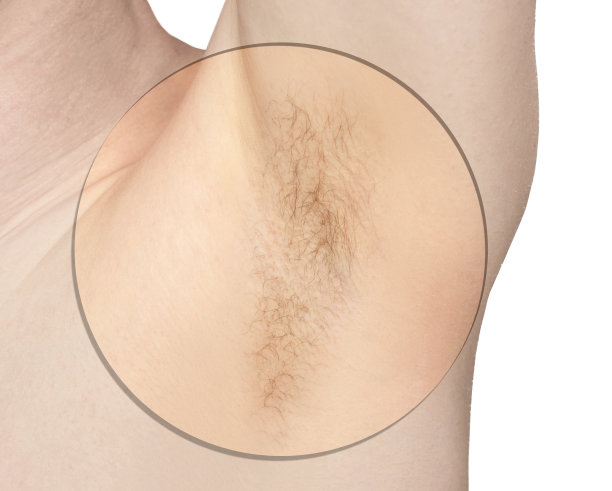 女孩腋下。白人腋窝。脱毛前后。图片下载