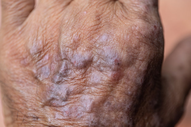 一种物理上的特应性皮炎(AD)，也称为特应性湿疹，是一种皮肤炎症(皮炎)。图片下载