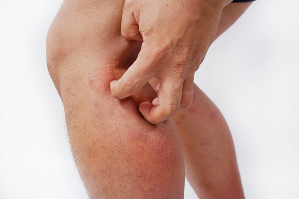 皮肤过敏图片下载