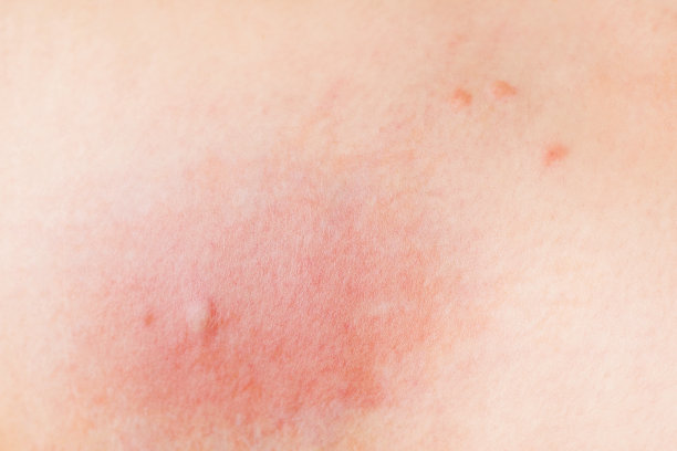 皮肤质地，对虫咬过敏，红肿。皮肤过敏反应图片下载