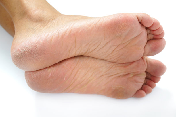 脚底干燥开裂，靠近图片下载