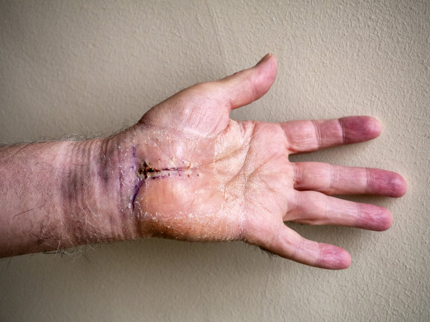 一名男子在腕管手术后两周，手上和手腕的伤口和鳞状皮肤正在愈合图片下载