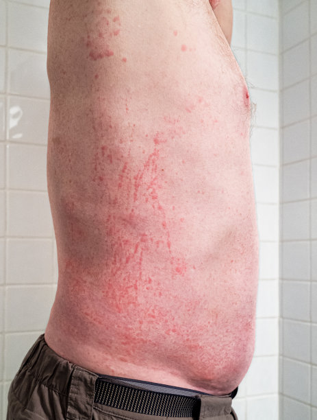 在医生办公室出现过敏皮疹图片下载