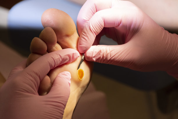 治疗脚上的老茧图片下载