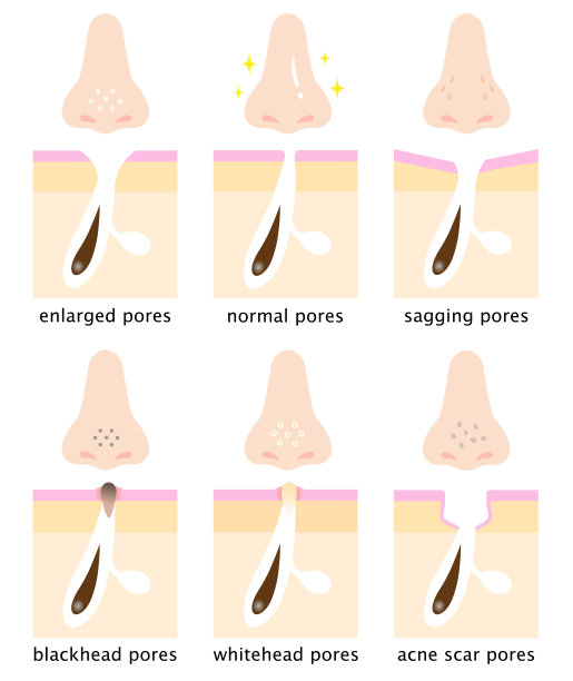 一套皮肤毛孔在人的鼻子和皮肤图。正常，下垂，开放，黑头，白头，痤疮疤痕。美容护肤理念图片下载