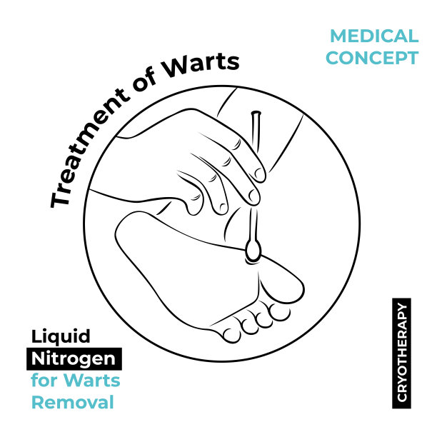 圆形图标关于疣的治疗。用液氮烧疣。一只手拿着一根氮气棒。图片下载