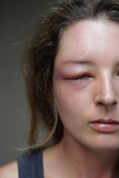 年轻的白种女人眼睛被黄蜂刺肿了。黄蜂叮咬后的过敏反应。图片下载