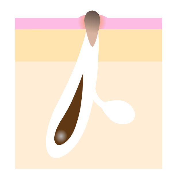 皮肤黑头毛孔层插图。美容面部和身体护理插图图片下载