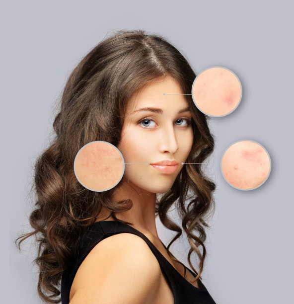 痤疮疤痕后/治疗痤疮疤痕。痤疮疤痕切除图片下载