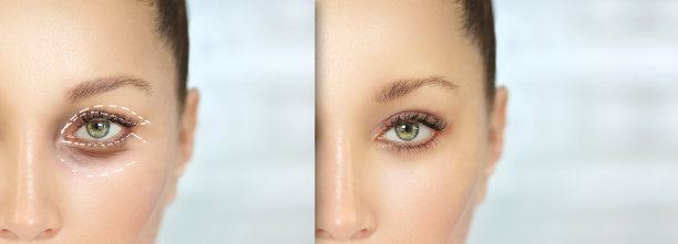 眼睑手术/眼睑成形术，整形外科，术前和术后图片下载