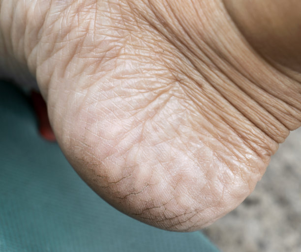 脚后跟干裂，皮肤干燥的女人从肮脏。概念治疗皮肤护理足和医学足科医生。图片下载