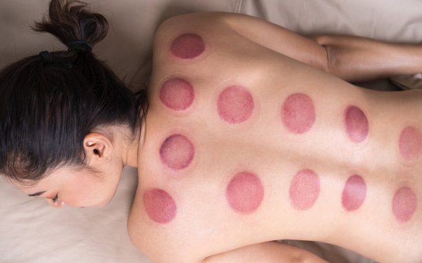 女子背部拔火罐图片下载