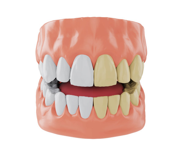 半颌与黄色的牙齿和半颌与美白的牙齿，前后美白概念，3d渲染图片下载