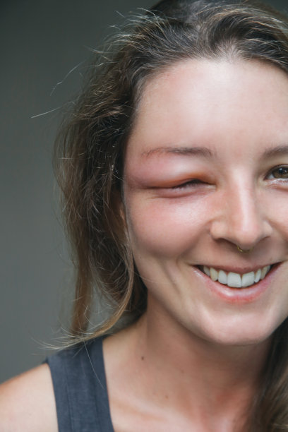 年轻的白种女人眼睛被黄蜂刺肿了。黄蜂叮咬后的过敏反应。图片下载