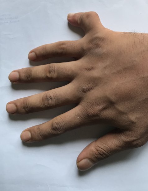 多指或多指畸形是指不正常的人手图片下载