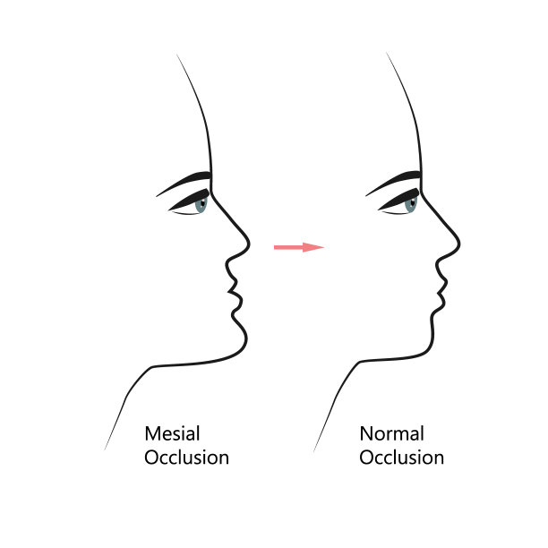 正畸治疗前后近中牙合情况。有错颌的人，下颚向前伸展，用牙套矫正咬合。矢量图图片下载