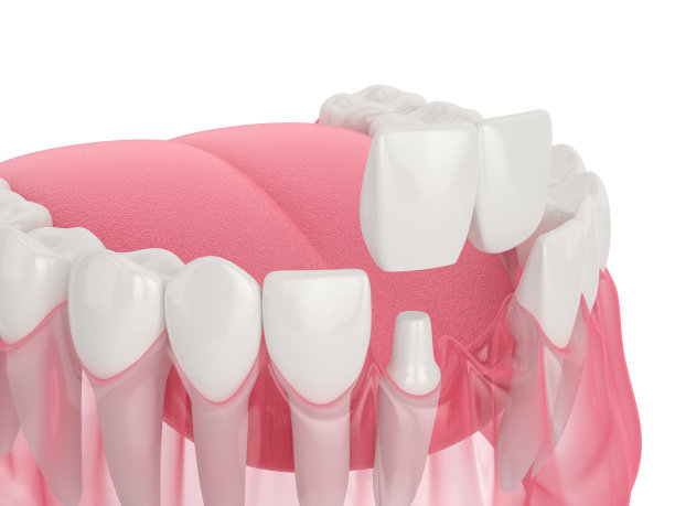 3d渲染颌骨与牙科悬臂桥图片下载