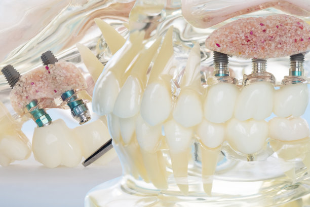 种植和正畸模型。图片下载