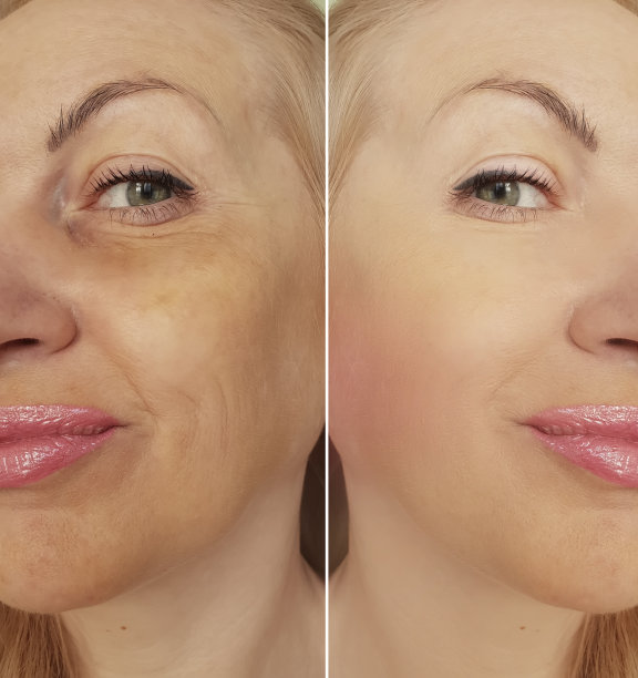 女性脸部皱纹治疗前后，拼贴，图片下载