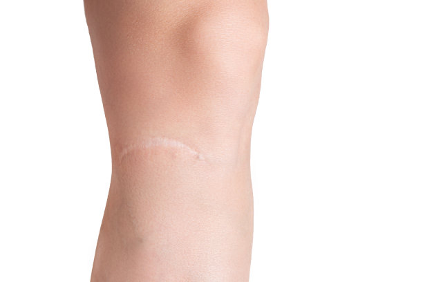 一个女孩腿上的伤疤特写。白色孤立背景下腿部受伤造成的静脉曲张图片下载